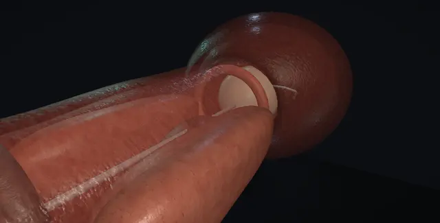 Operative plate: Optilume BPH: the drug-coated balloon