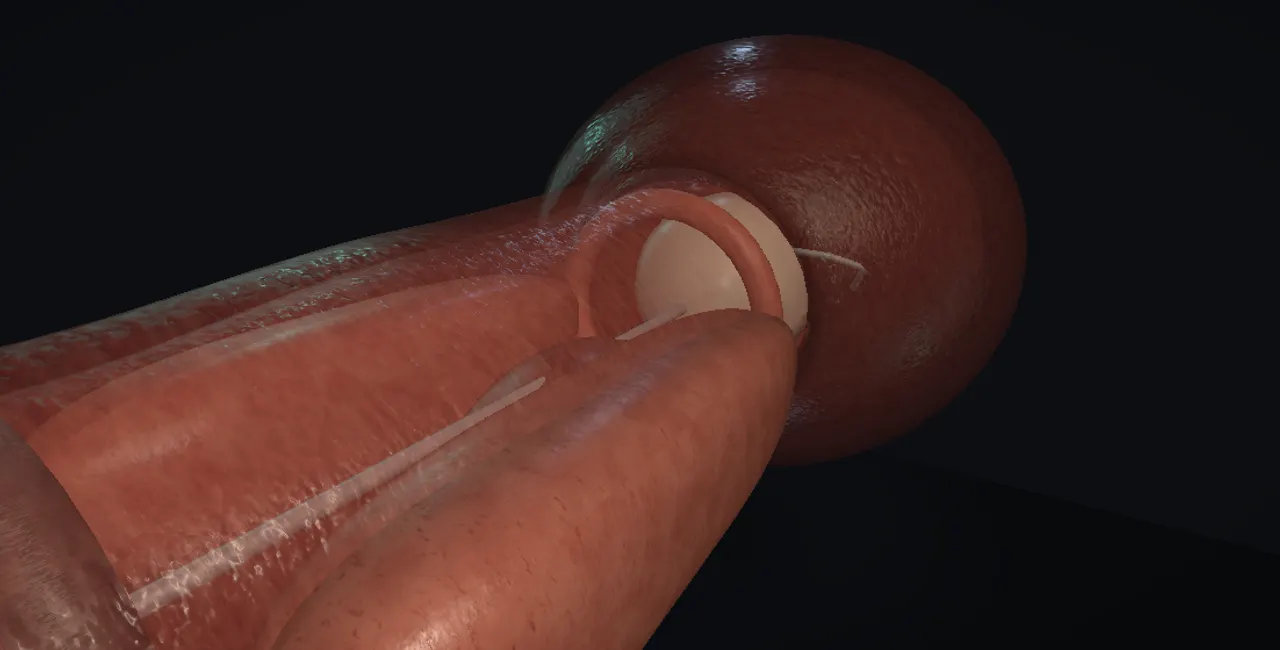 Rendered frame from the Interactive drug-coated balloon dilation