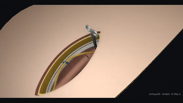 Operative plate: Radical inguinal orchidectomy
