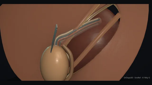 Operative plate: Orchidopexy