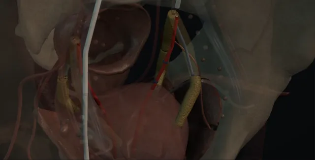 Operative plate: Prostatic artery embolisation