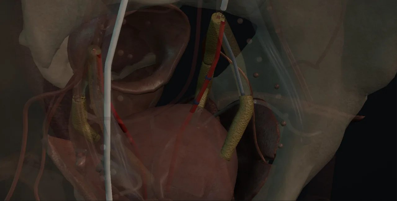 Rendered frame from the Interactive prostatic artery embolisation