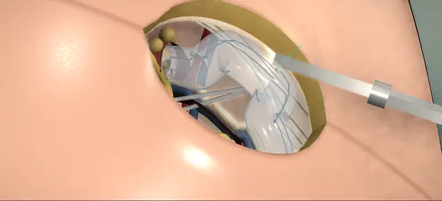Operative plate: Paediatric inguinal hernia repair