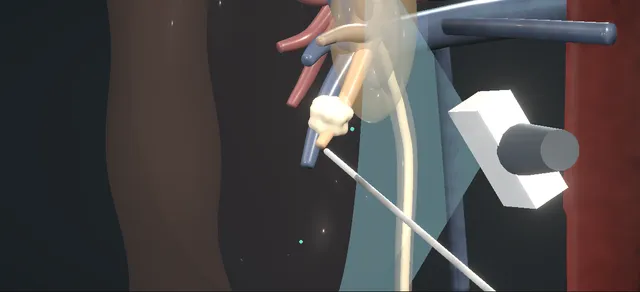 Operative plate: Paediatric stone procedures