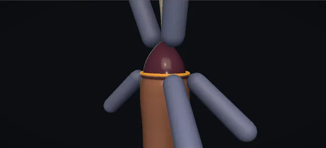 Operative plate: Acute paraphimosis