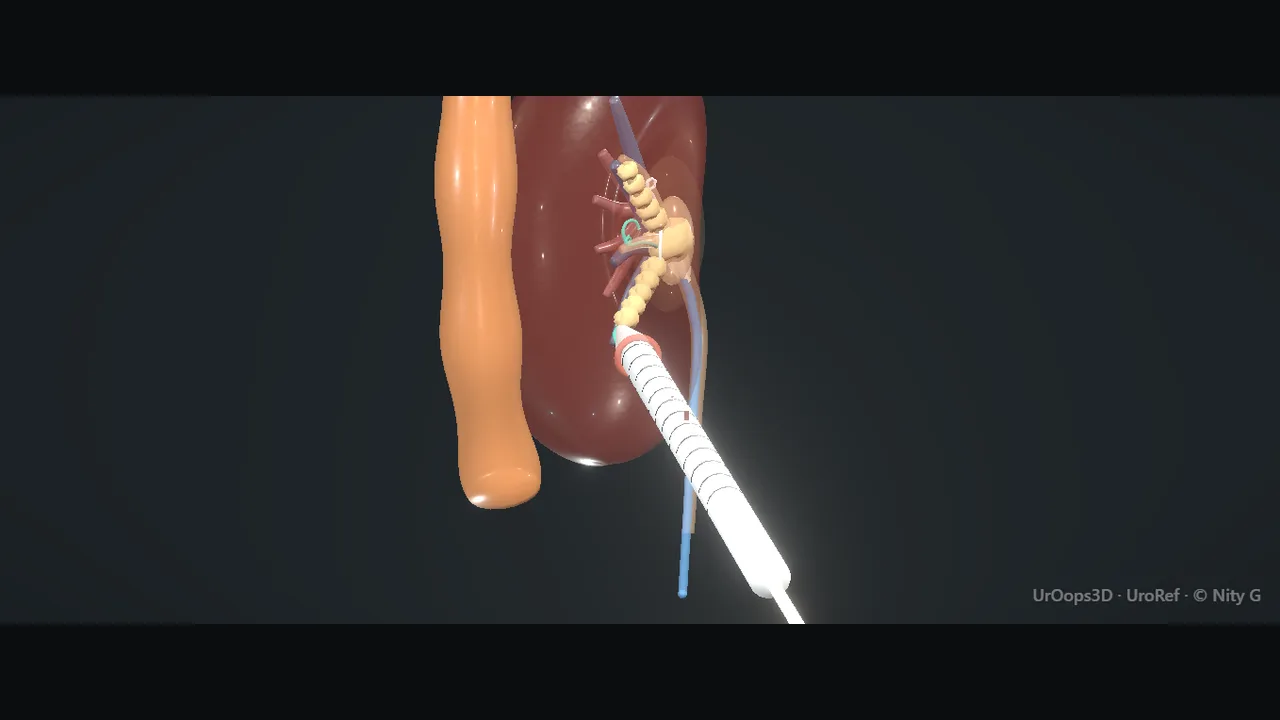 PCNL: the dilated tract and the working sheath in the collecting system