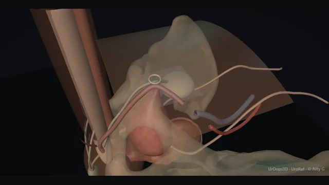Operative plate: Inflatable penile prosthesis