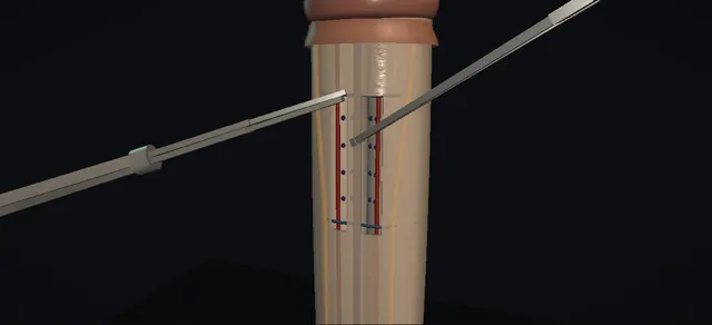 Operative plate: Penile plication: Lue sixteen-dot
