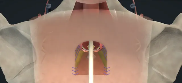Operative plate: Perineal urethrostomy: inverted-U flap
