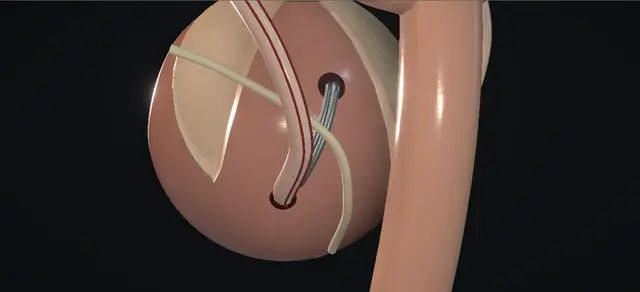 Operative plate: Politano-Leadbetter ureteric reimplantation