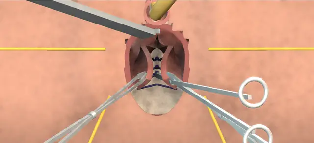 Operative plate: Rectocele repair