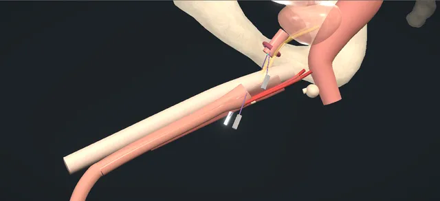 Operative plate: Posterior urethral reconstruction