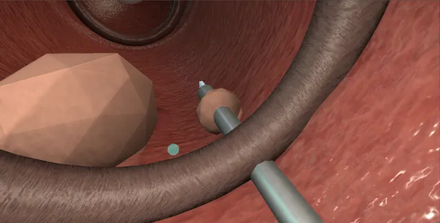 Operative plate: Posterior urethral valve ablation