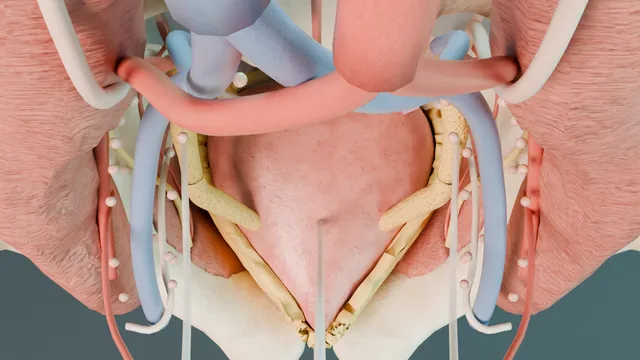 Operative plate: Radical cystectomy + PLND: pelvic atlas