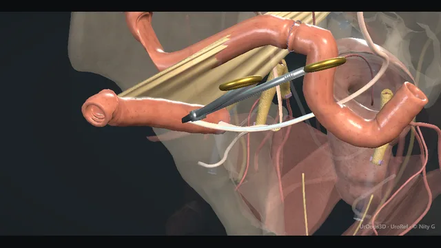 Operative plate: Radical cystectomy + conduit