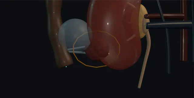 Operative plate: Renal tumour ablation