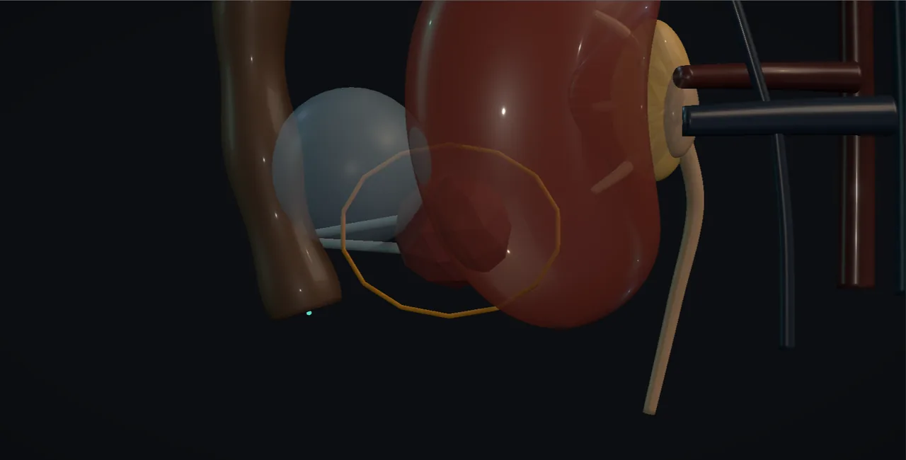 Rendered frame from the Interactive percutaneous tumour ablation