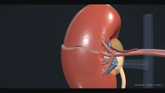 Operative plate: Blunt renal trauma