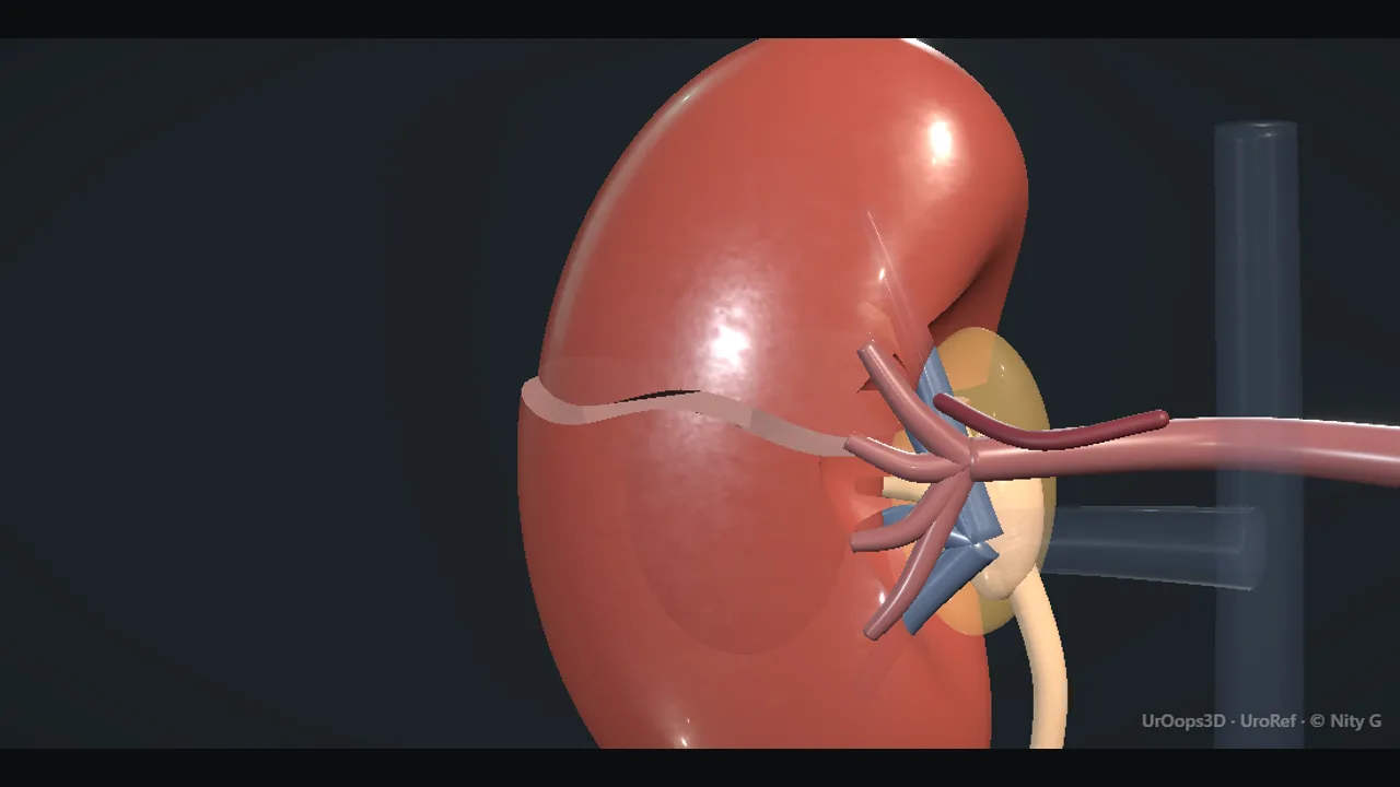 Plate from the linked animation. Schematic to come: CT with a laceration and contrast blush, perirenal haematoma