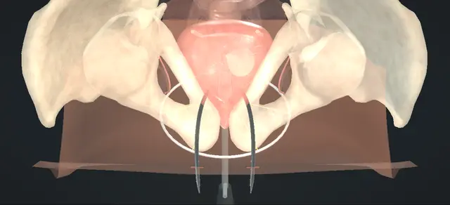 Operative plate: Retropubic sling