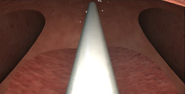 Operative plate: Rezum water-vapour therapy