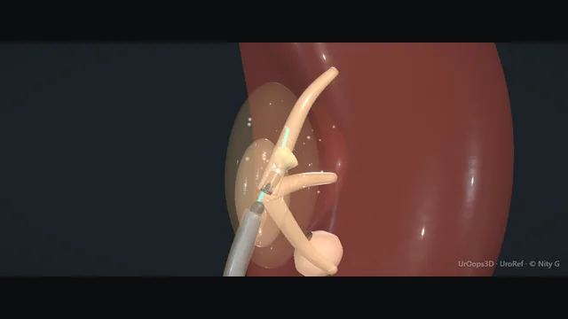 Operative plate: Flexible ureterorenoscopy