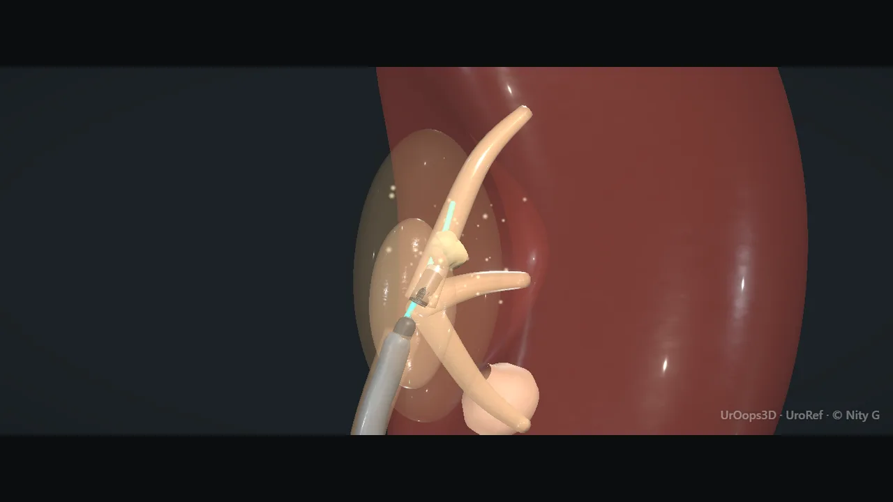 Flexible ureterorenoscope view: laser dusting of a renal pelvic stone
