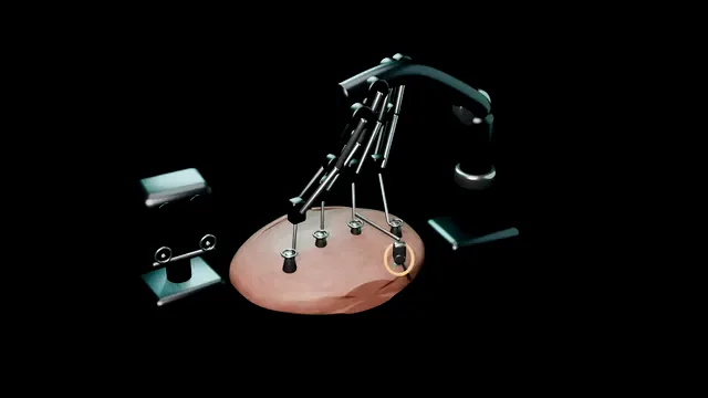 Operative plate: Robotic surgery: the basics