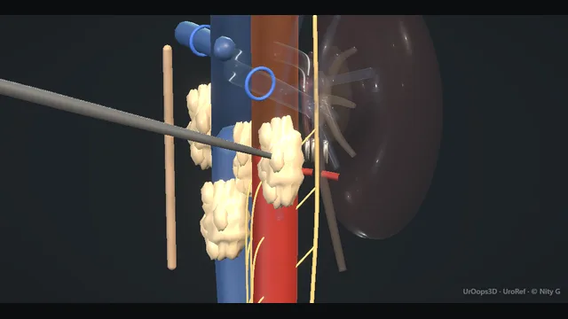 Operative plate: Retroperitoneal node dissection