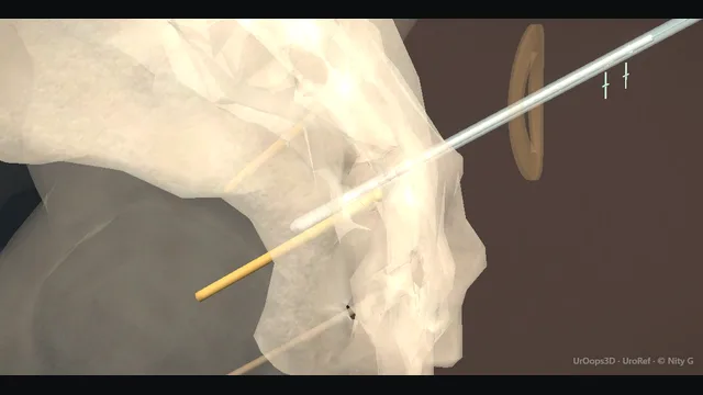 Operative plate: Sacral neuromodulation