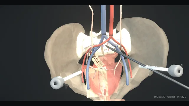 Operative plate: Laparoscopic sacrocolpopexy