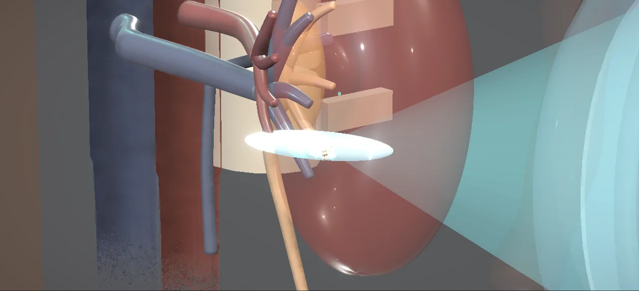 Rendered frame from the Interactive shock wave lithotripsy
