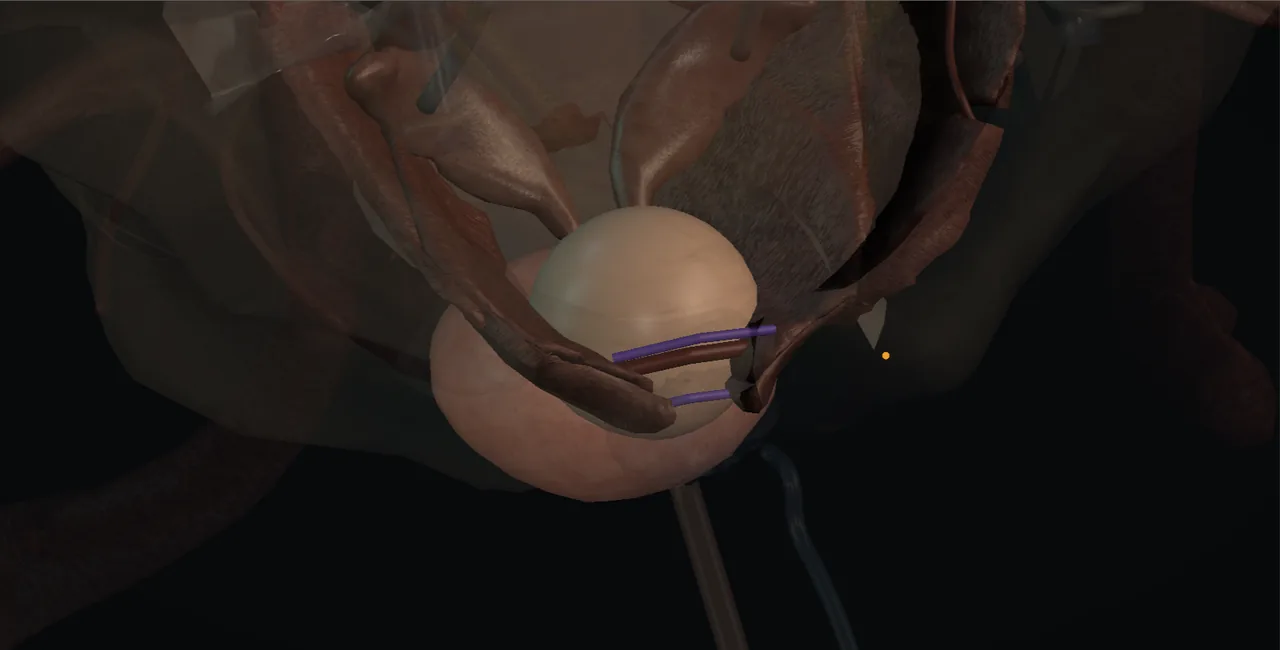 Rendered frame from the Interactive Millin prostatectomy