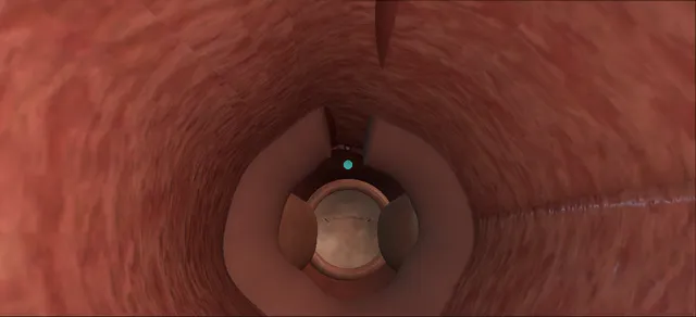 Operative plate: External sphincterotomy