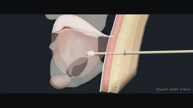 Operative plate: Suprapubic catheter