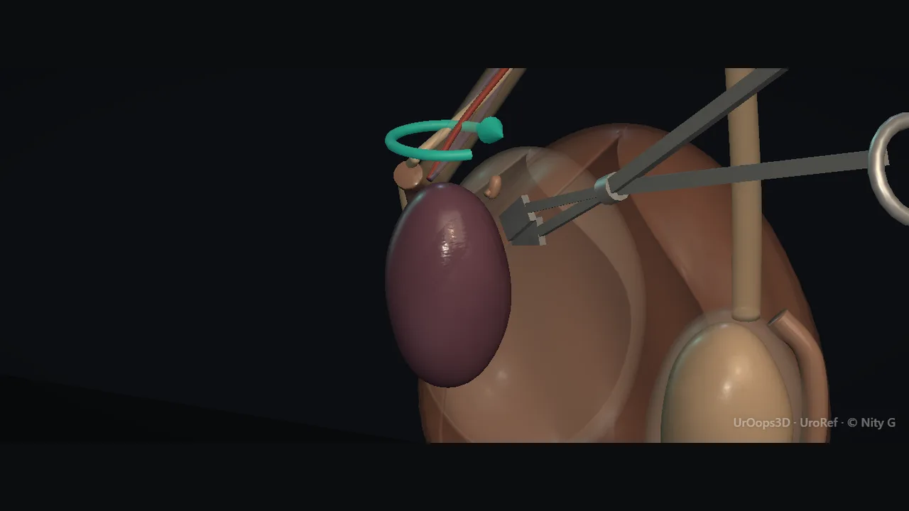 Scrotal exploration: the testis and cord in torsion
