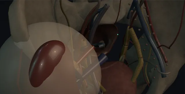 Operative plate: Transplant nephrectomy