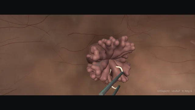 Operative plate: Bladder tumour resection