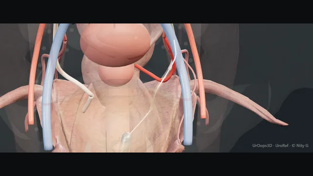 Operative plate: Ureteric injury: recognition and repair