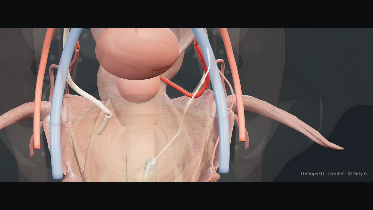 Rendered frame from the Interactive ureteric injury: recognition and repair
