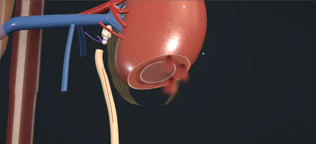 Operative plate: Ureterocalicostomy
