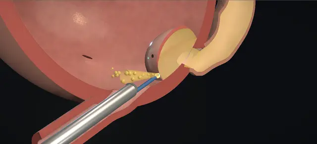 Operative plate: Ureterocele incision