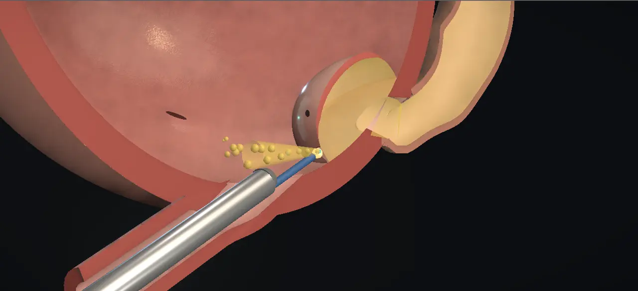 Rendered frame from the Interactive endoscopic ureterocele incision
