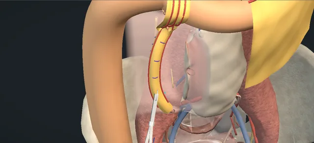 Operative plate: Ureterolysis with omental wrapping