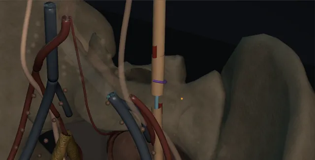 Operative plate: Ureteroureterostomy