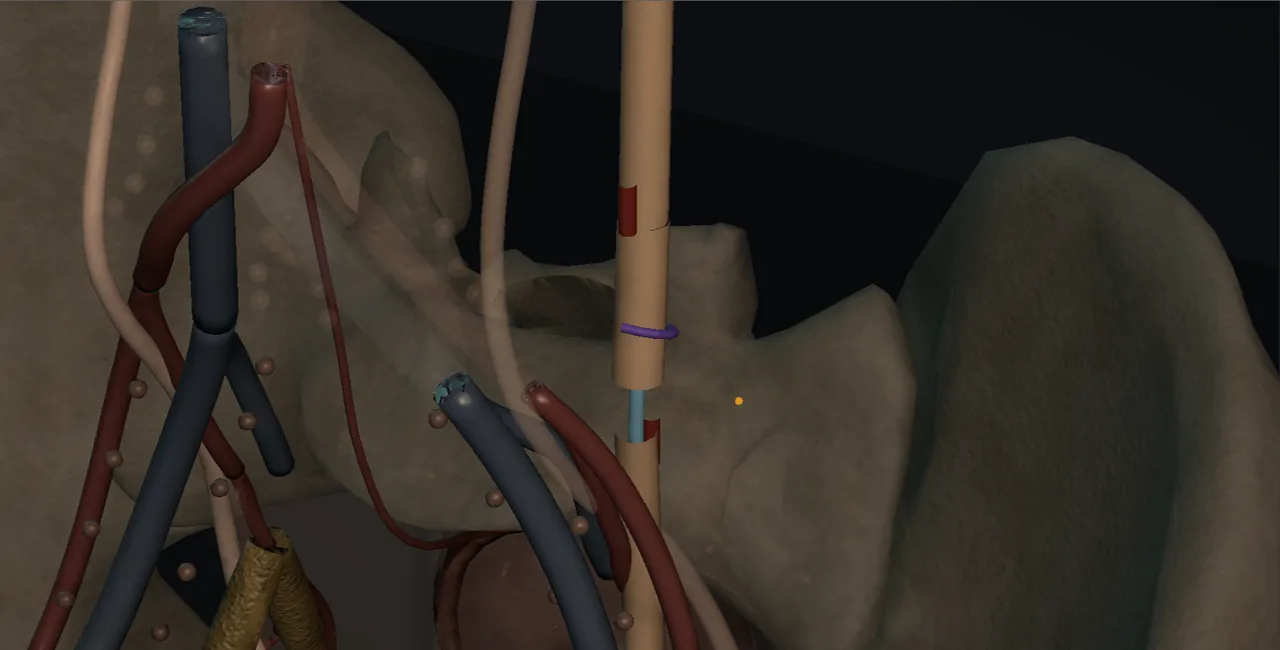 Rendered frame from the Interactive ureteroureterostomy