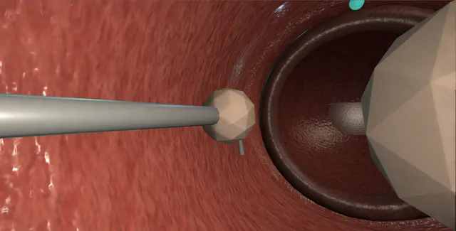 Operative plate: Urethral bulking injection