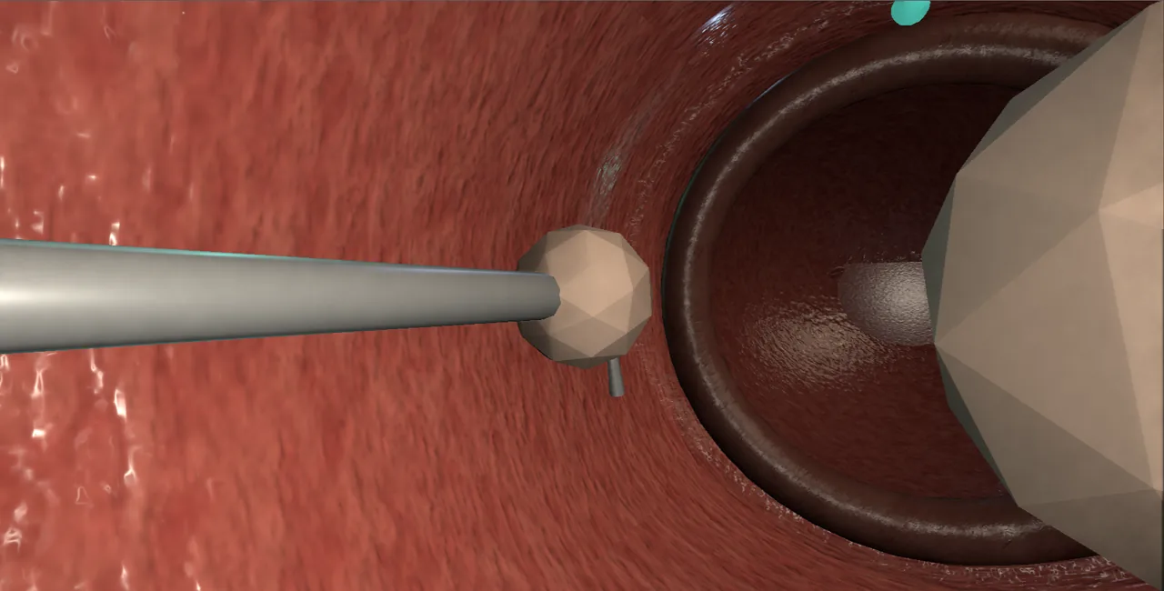 Rendered frame from the Interactive urethral bulking injection