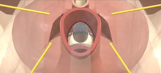 Operative plate: Female urethral diverticulectomy