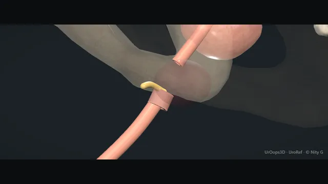 Operative plate: Pelvic fracture urethral injury